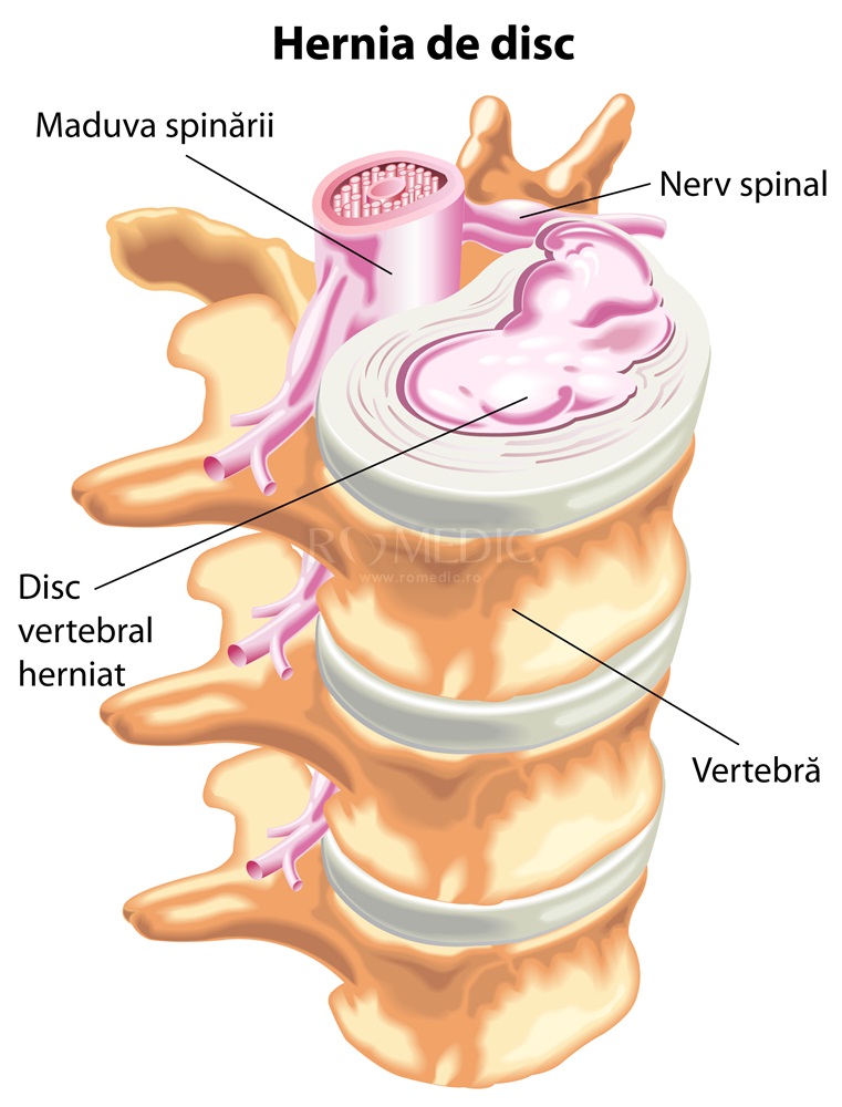 hernie vertebrală și dureri articulare