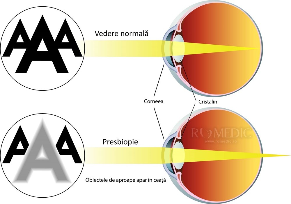 viziunea asupra vârstei cum să se îmbunătățească pierderea vederii din cauza nervilor