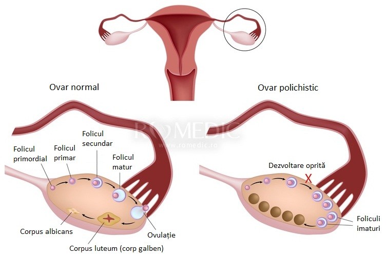 Chistul Ovarian