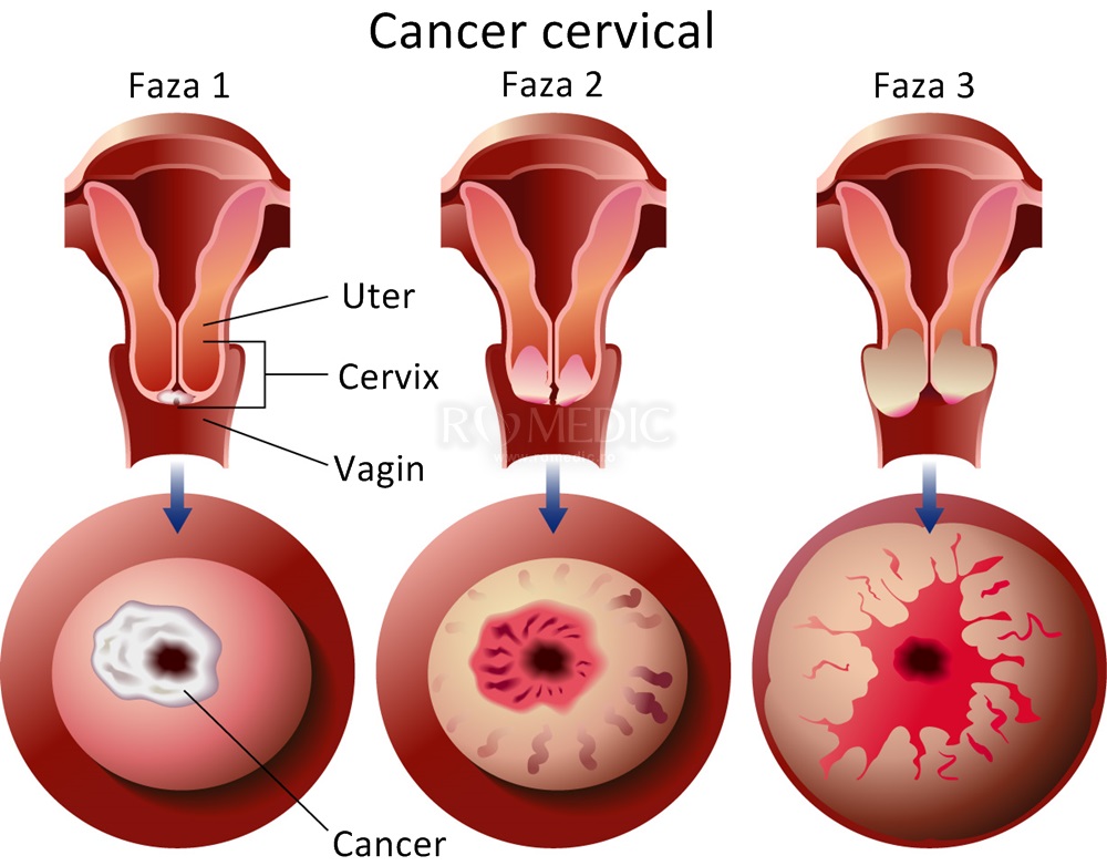 cancerul este vindecabil acum