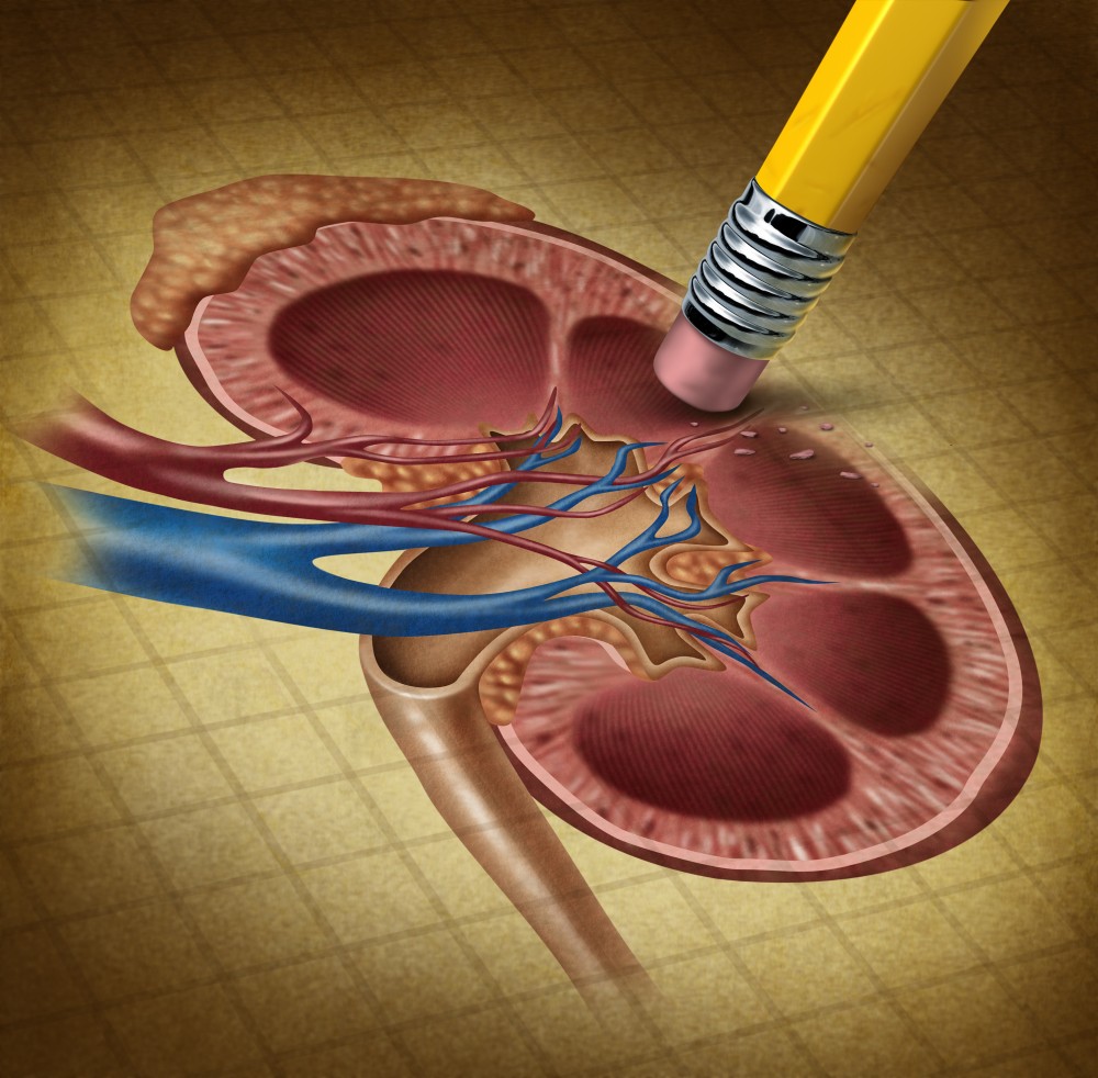 Cancer renal: simptome, cauze, tratament, prevenţie