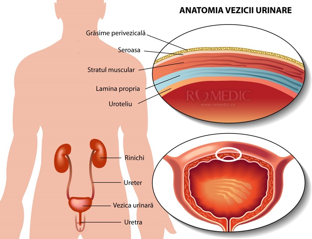 Cancer / tumora de vezica urinara - sincanoua.ro