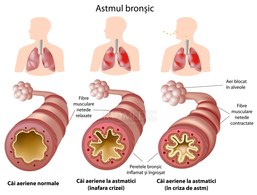 tratamentul bronhiilor și articulațiilor