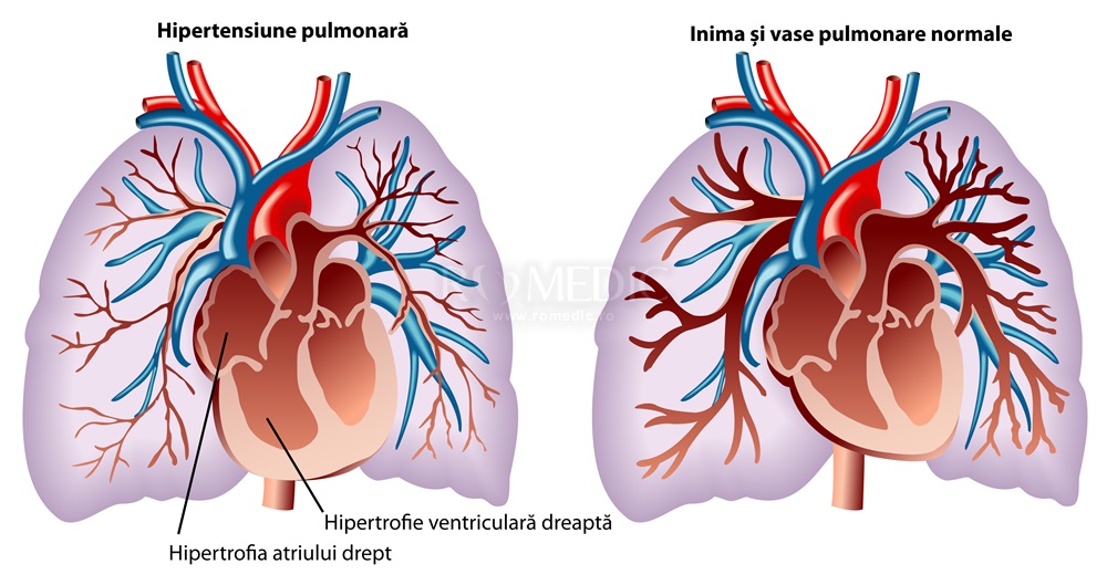 Hipertensiune arterială