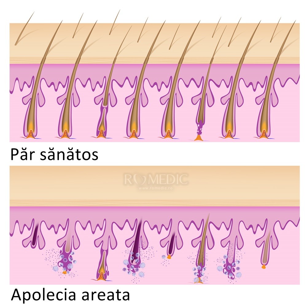 Pelada Alopecia Areata