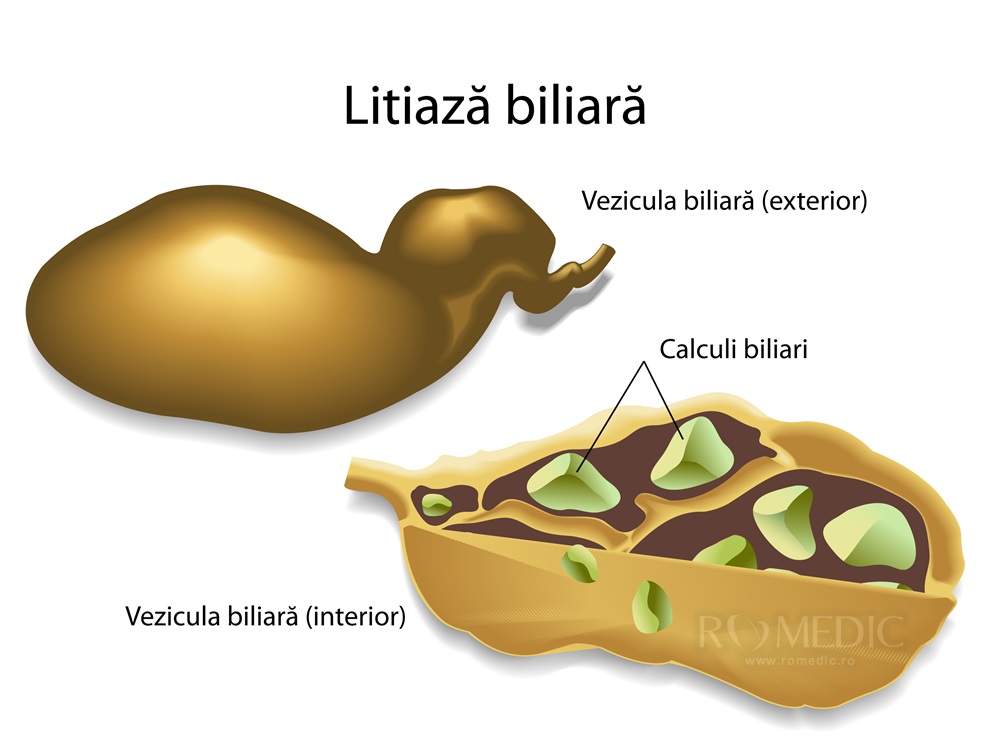 Litiaza biliara