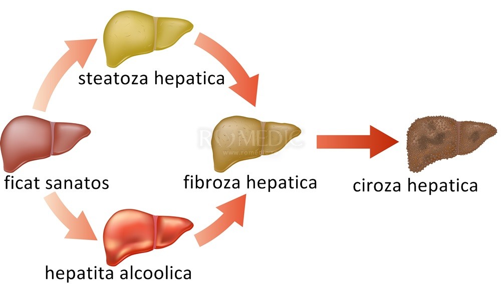 boala hepatica în varicoza)