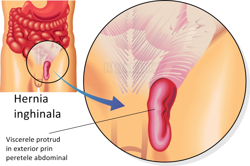 Hernia inghinala