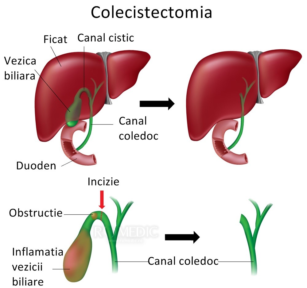 Sindromul Postcolecistectomie