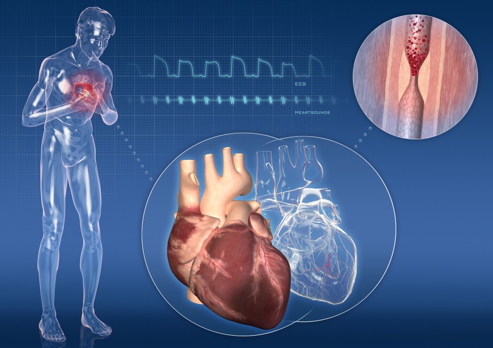 angina pectorală dureri articulare