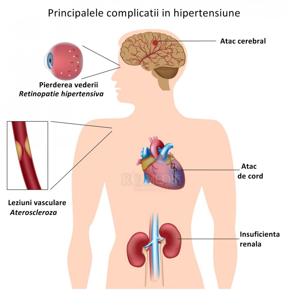 afectarea vederii în bolile vasculare antioxidanți pentru vedere