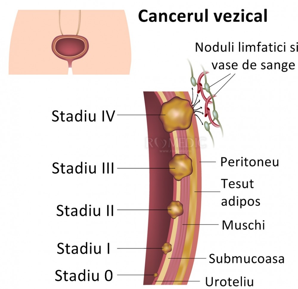 cancerul de vezica urinara simptome)