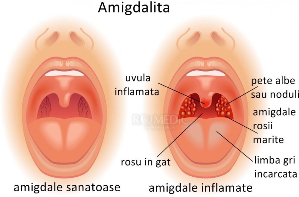 După îndepărtarea amigdalelor, articulațiile nu au mai rănit