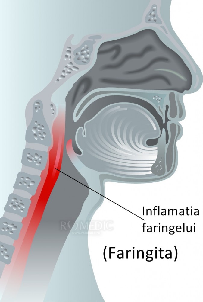 Faringita