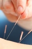 Acupunctura in nevralgia trigeminala