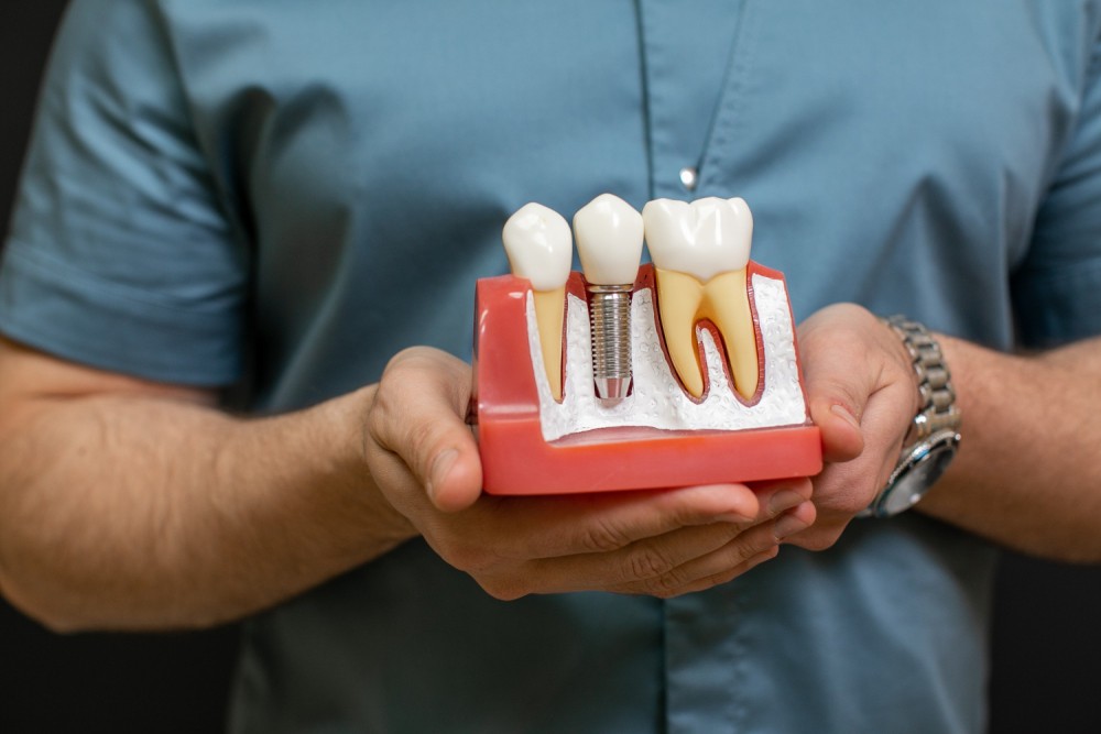 De ce calitatea sistemului de implant influențează direct rata de succes pe termen lung a tratamentului