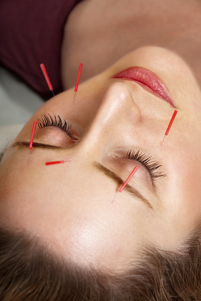 Acupunctura cosmetica