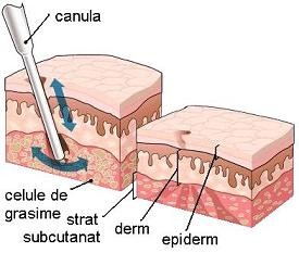 Liposuctie