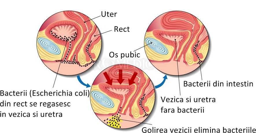 Infectie urinara tratament rapid