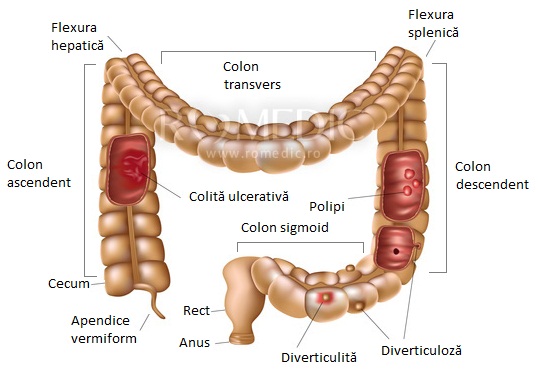 tumora maligna colon