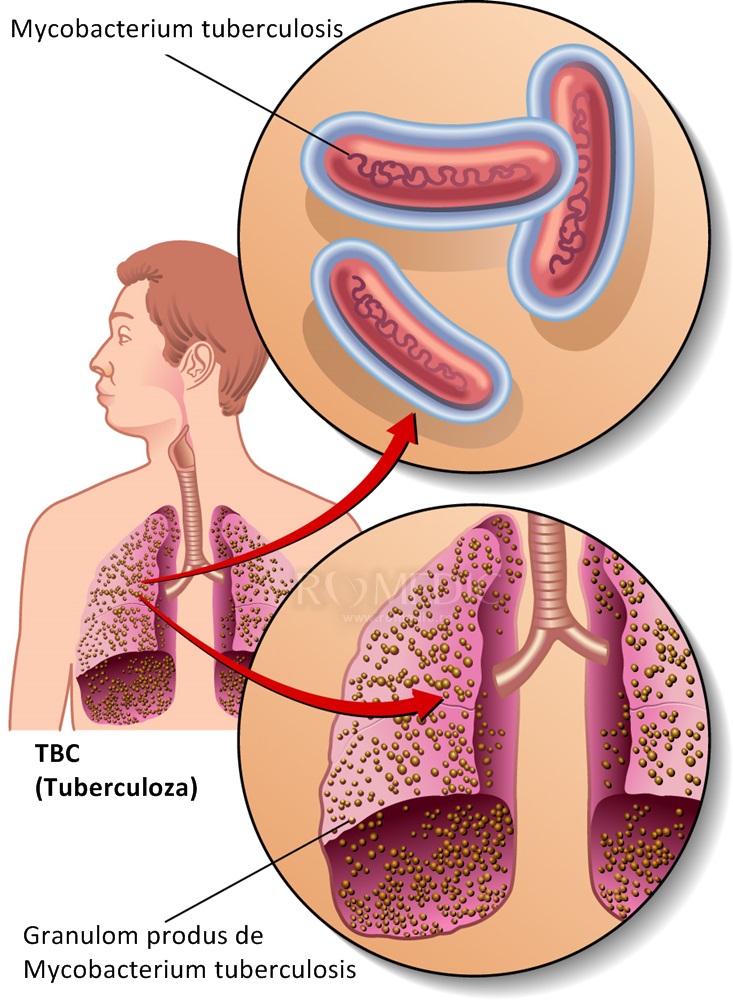 mecanismul de pierdere în greutate de tuberculoză