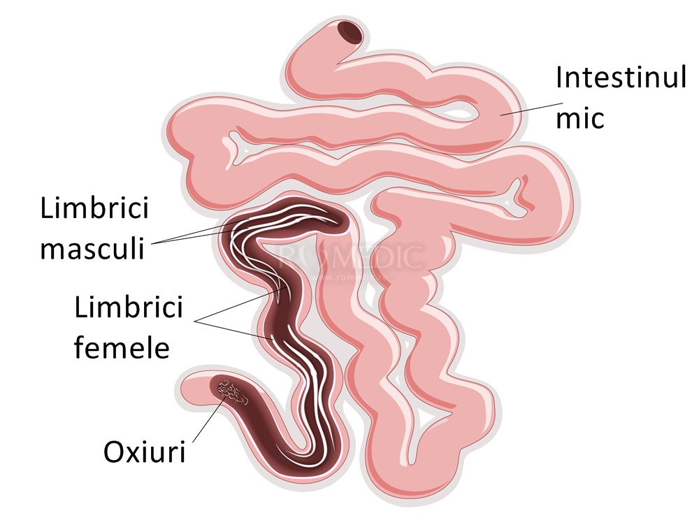 paraziti intestinali limbrici tratament)