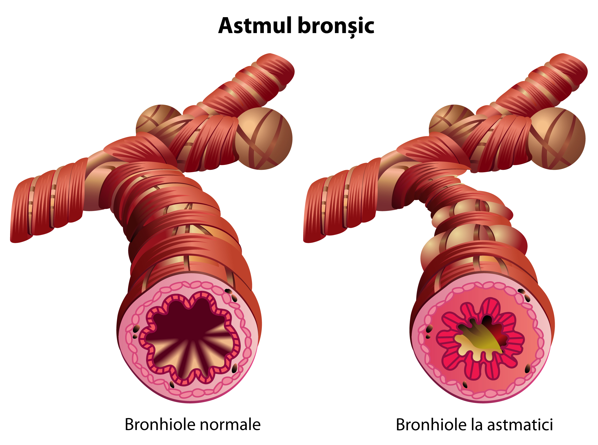 astmul inhalatorii pierderii în greutate)