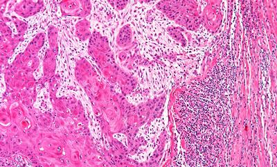 Un nou medicament ar putea îmbunătății rata de succes a imunoterapiei pentru cancer