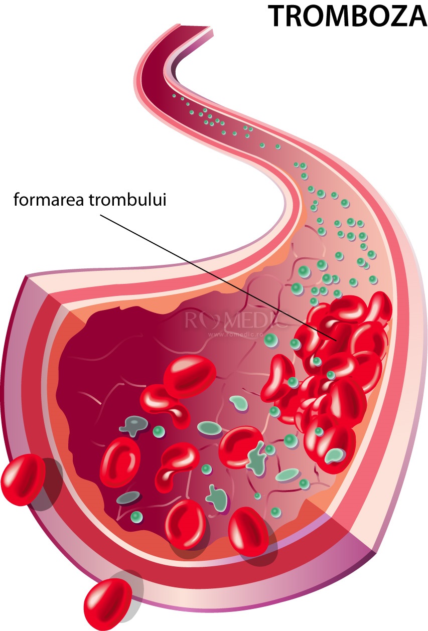 formarea trombului în varicoza