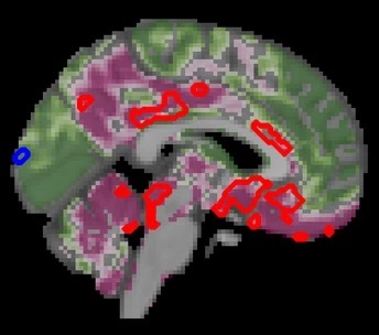 Diabetul de tip 2 accelerează îmbătrânirea creierului și declinul cognitiv