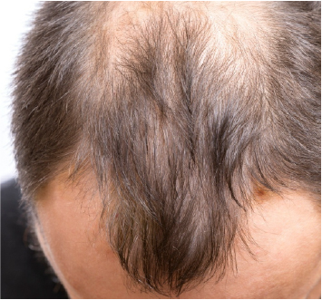 Legătură între sistemul imunitar și creșterea părului