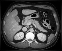 Pregătirea pacientului pentru tomografia computerizată (CT) abdominală