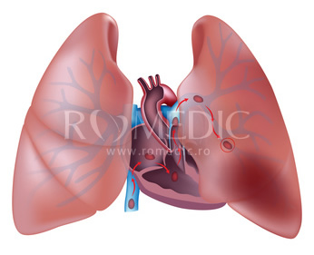 Tratamentul cu sistemul FlowTriever îmbunătățește simptomele și calitatea vieții pacienților cu embolie pulmonară