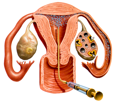 Inseminarea artificiala