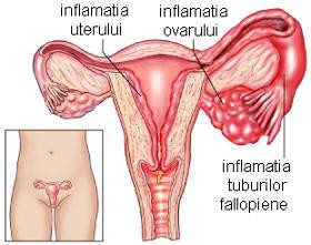 varicose pelvis la femei