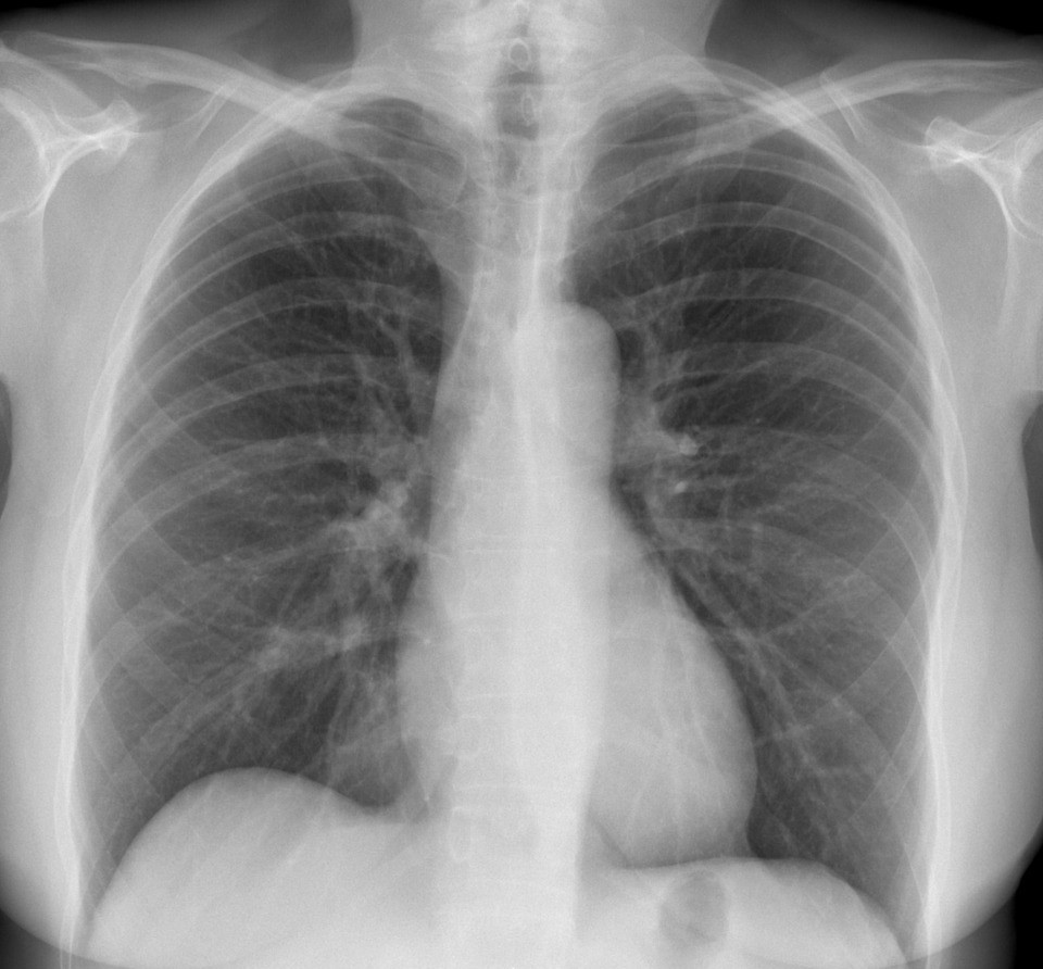 Afectarea pulmonară în cadrul bolilor de sistem