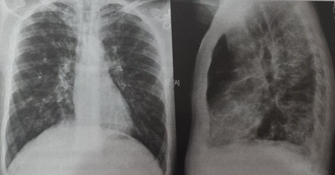 boala sistemică a țesutului conjunctiv cu leziuni pulmonare