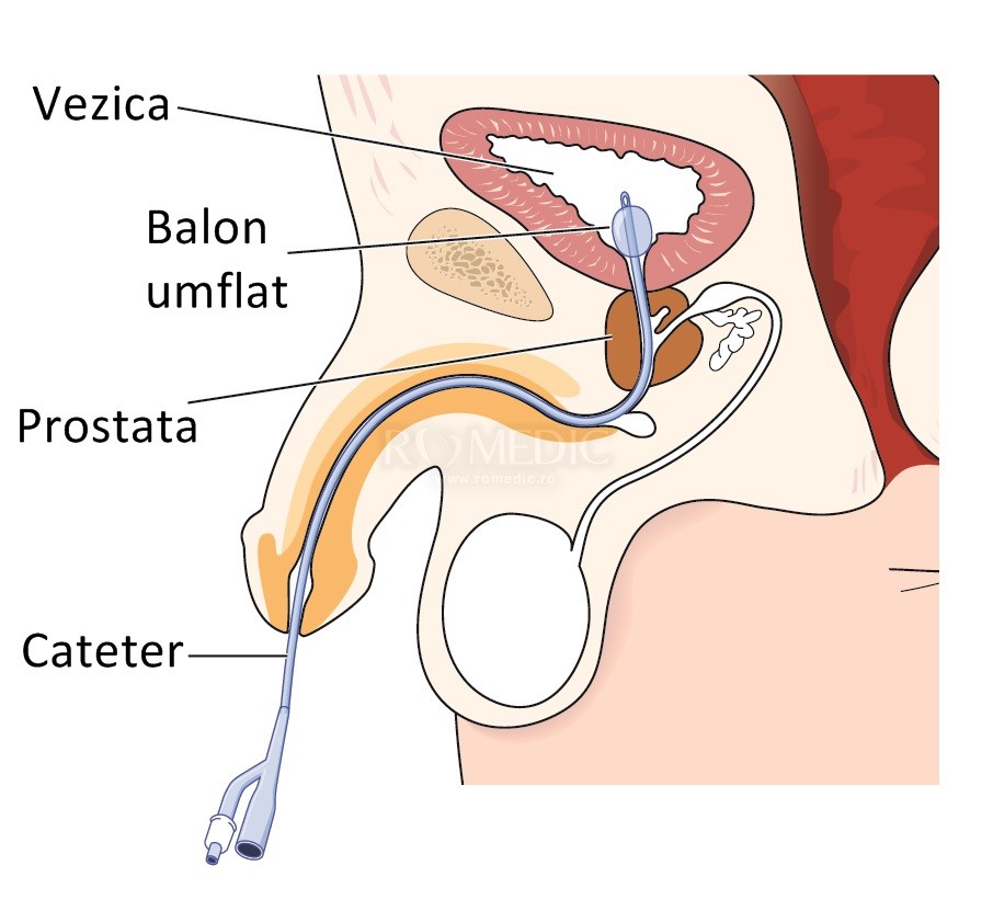 cum se scoate sonda urinara