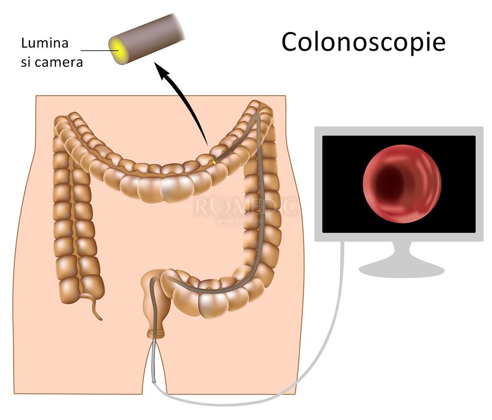 Întrebări frecvente în bolile inflamatorii intestinale - Studii Clinice