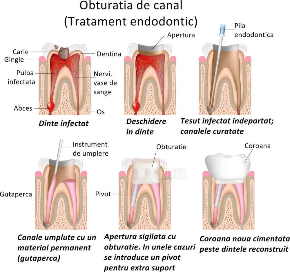 Terapia canalului radicular (endodonție) -