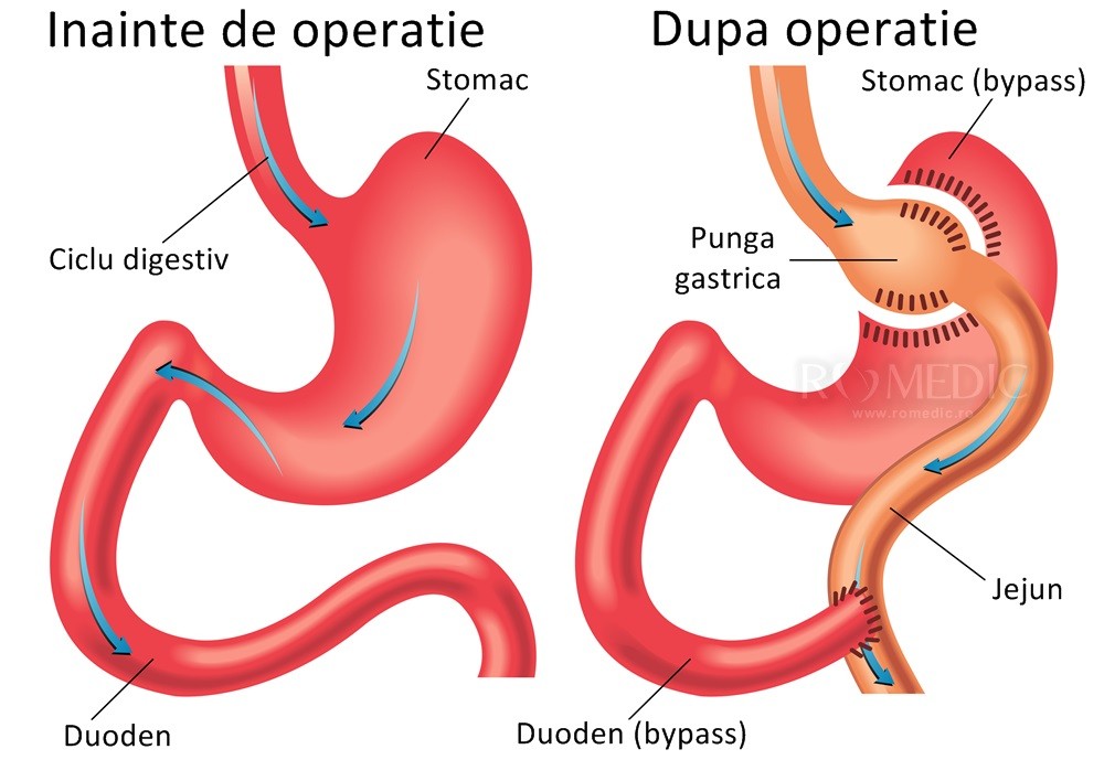 pierde sindromul de dumping de greutate)