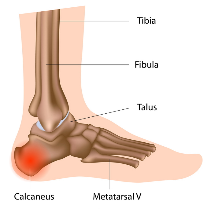 Durerea de calcai â din ce cauza apare, ce remedii functioneaza si cand sa mergi la medic