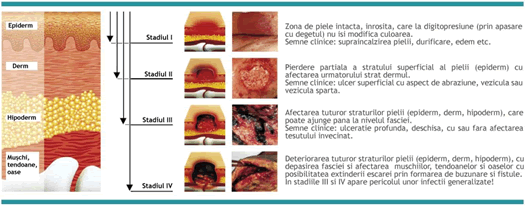 Clasificarea escarelor