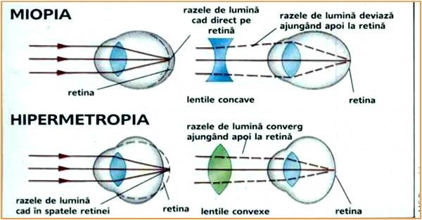 poate fi atât miopie, cât și hipermetropie