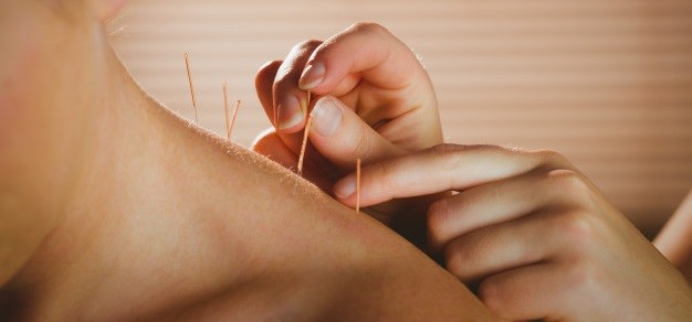 10 afecțiuni tratate prin acupunctură