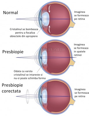 Putem preveni presbiopia?